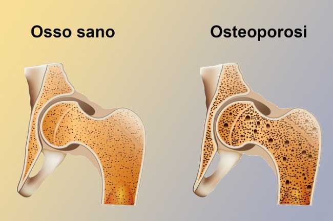osteoporosi